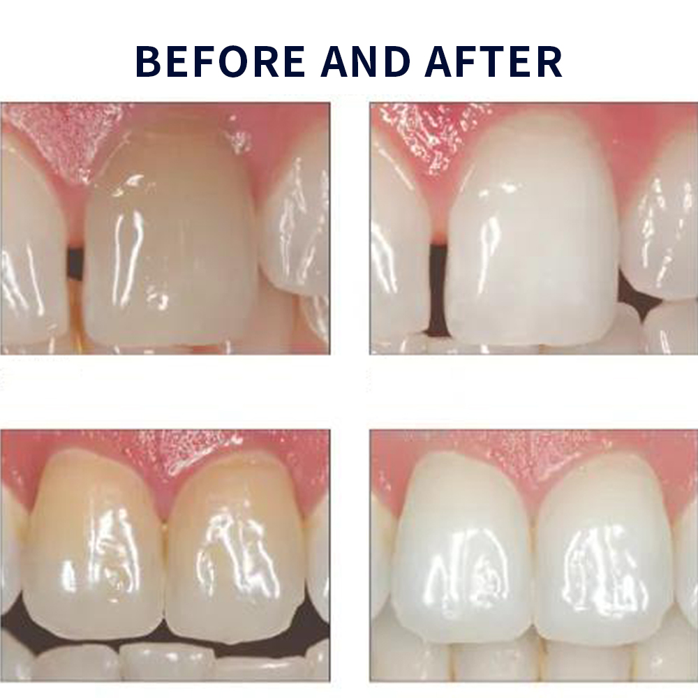 Opalescence Whitening 20% PF 2 - đánh giá và giá Teeth Whitening Near Me