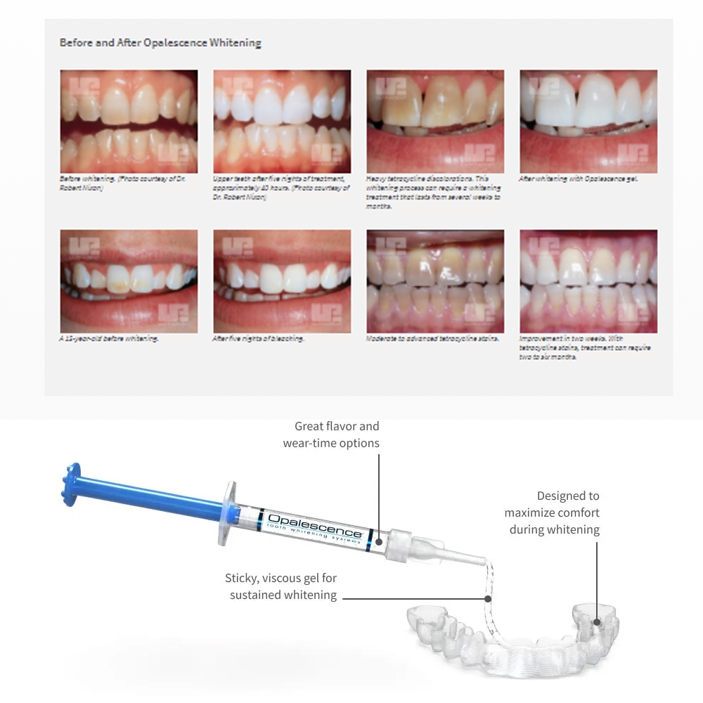 Opalescence Whitening 20% PF 2 - đánh giá và giá Teeth Whitening Near Me